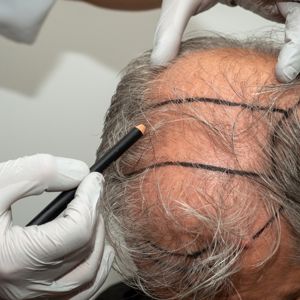 Cost of Hair Transplant